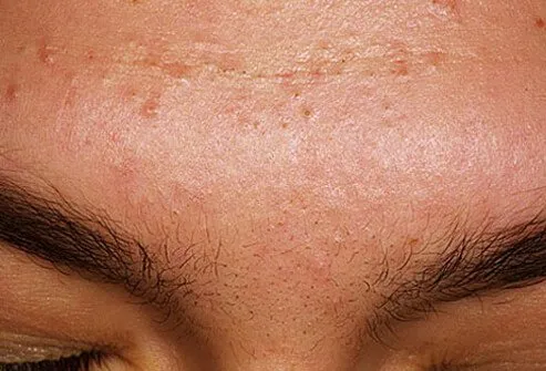 Acne mechanica is caused by a combination of factors.