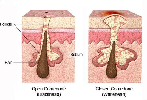 Comedones are clogged pores that fill with sebum (oil and cellular debris).