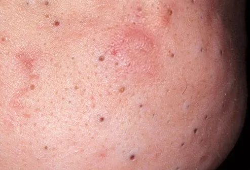 Blackheads appear on the skin as tiny black dots.