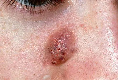 Acne cysts are closed pockets of tissue filled with pus.