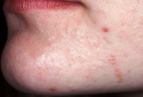 Acne may be mild.