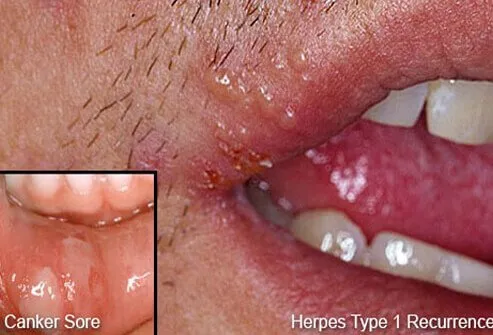 Picture of Cold Sore and Canker Sore