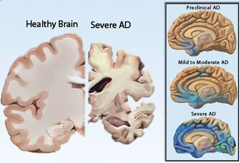 Picture of Alzheimer's Disease 