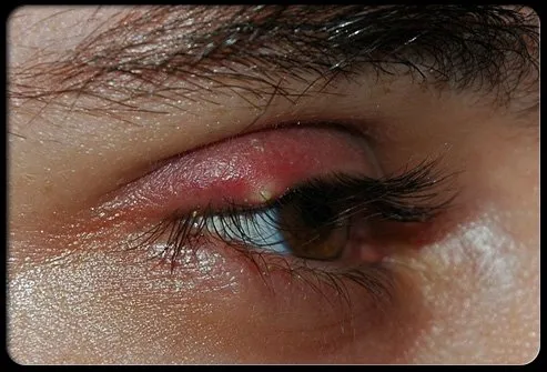 A sty (also spelled stye) is an infection of the oil gland at the base of an eyelash.