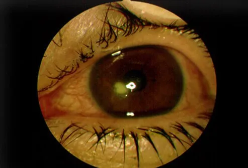 A corneal ulcer is a common eye condition. 