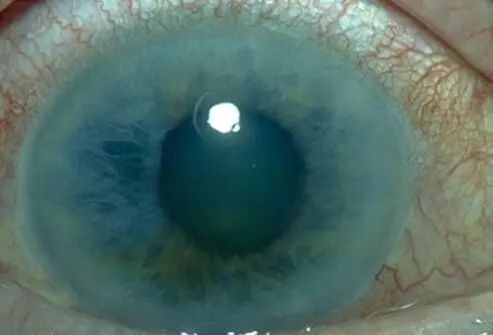 Picture of Glaucoma 