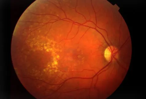 Age-related macular degeneration is an eye disease that can begin at any age, but usually develops after age 60. 