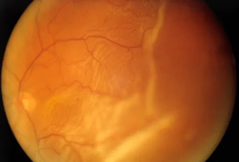 Retinal detachment occurs when the retina (tissue in the back of the eye) separates (detaches) from its underlying structures.