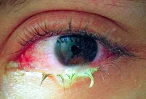 Conjunctivitis, or pinkeye, is an eye diseases that causes redness and inflammation of the clear tissue covering the eye and the inside of the eyelids (conjunctiva).