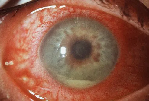 Uveitis is inflammation to the middle layers of the eye (the uvea).