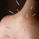 How Does Acupuncture Work? Benefits, Needles, Definition