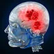 Brain Cancer: Tumor Signs, Symptoms, and Treatment