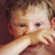 Childhood Diseases: Measles, Mumps, & More