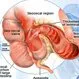 Crohn's Disease: Symptoms, Causes, Diet