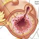 Diverticulitis (Diverticulosis) Symptoms, Diet, Treatment