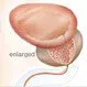 Enlarged Prostate (BPH) Symptoms, Diagnosis, Treatment