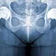 Osteoarthritis: Guide to Hip Replacement