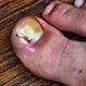 Ingrown Toenails: Infection, Causes, Prevention, Surgery