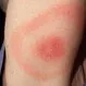 What Is Lyme Disease? Symptoms, Rash, Treatments