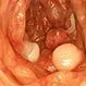 What Is a Polyp? Nasal, Colon, and Other Polyps