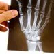 What Is Rheumatoid Arthritis (RA)? Symptoms, Treatment, Diagnosis