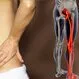 What Is Sciatica? Symptoms, Causes, Treatments