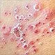 Viral Skin Conditions: Pictures of Rashes, Blisters, and Sores in Adults and Toddlers