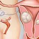 What Are Uterine Fibroids? Symptoms, Treatment, Pictures