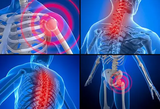 Fibromyalgia is a chronic condition that causes pain, stiffness, and tenderness of muscles, tendons, and joints.