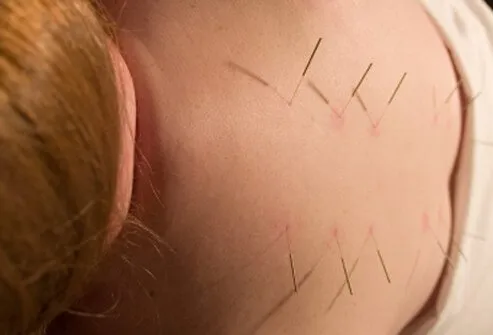 Acupuncture has also been reported to be effective in treating some patients with fibromyalgia.