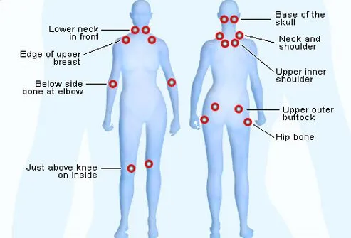 Fibromyalgia tender points are localized areas of the body that are tender to light touch.