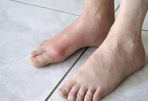 The sudden onset of redness, pain, and swelling of the big toe joint is a classic example of gout.