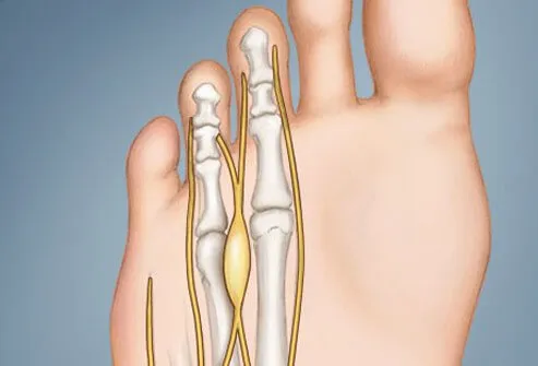 A pain in the ball of the foot that is sharp, burning, numbing, and/or tingling with radiation into the toes may be from a neuroma.