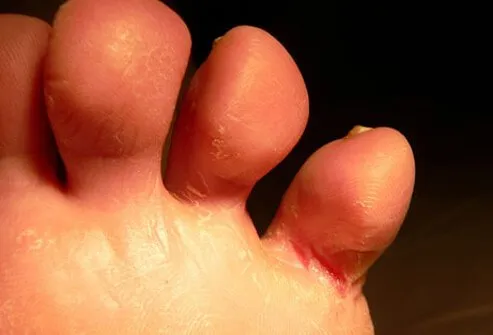 The most common cause of itchy feet is athlete's foot.