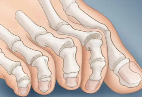 A claw toe deformity is a curling of the lesser toe joints.