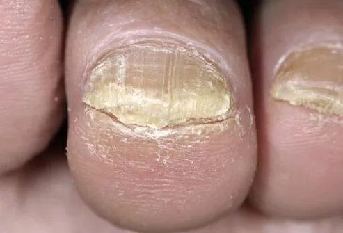 Onychomycosis is a fungal infection of the nails that causes discoloration and thickening of the toenails may cause yellow toenails.