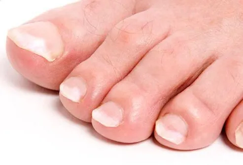 Toes with white nails.