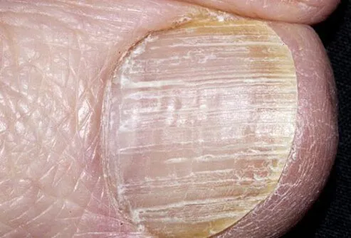 Nail pitting is most commonly seen in people who suffer from psoriasis.