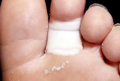 If your toes turn white, then blue, and red again with a blotchy appearance, you may have Raynaud's disease.