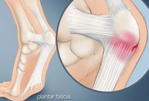 Plantar fasciitis is the most common cause of heel pain.