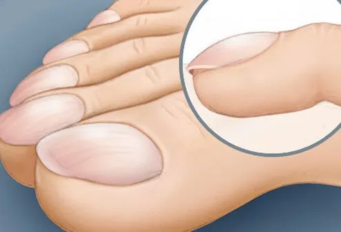 Clubbing of the toes refers to the structural shape of the toes.