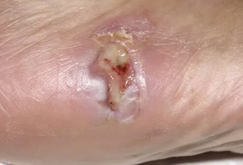 Sores on the feet that don't heal are a major cause for concern.