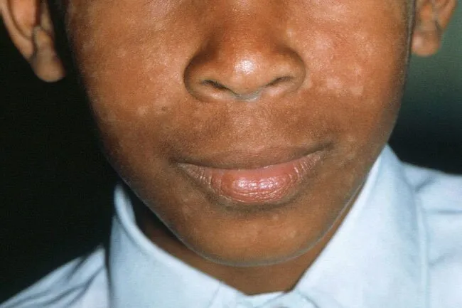 There is some evidence that Black people may be more likely to develop seborrheic dermatitis.