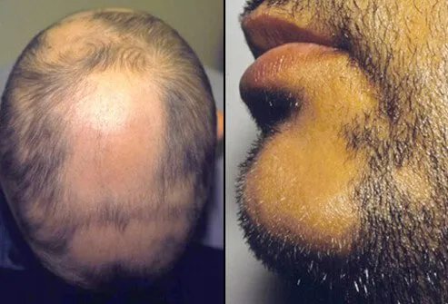 Alopecia Areata