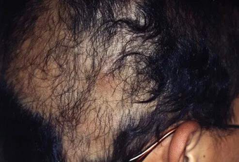 Trichotillomania