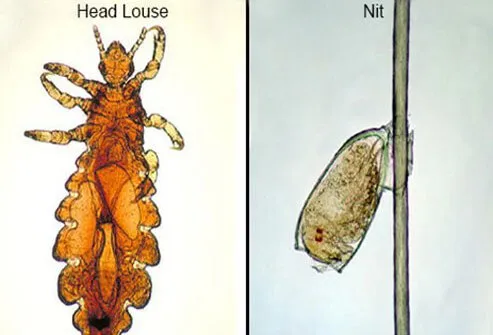 The common head louse is an insect which attaches itself to the scalp and feeds off of human blood.