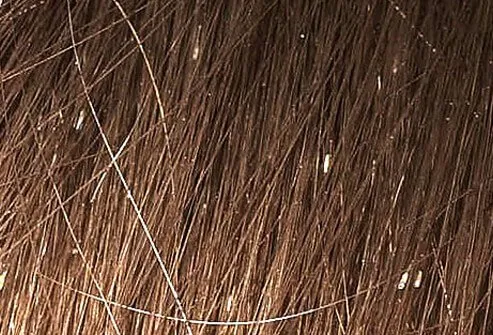 Lice and their eggs (nits) are visible to the naked eye.