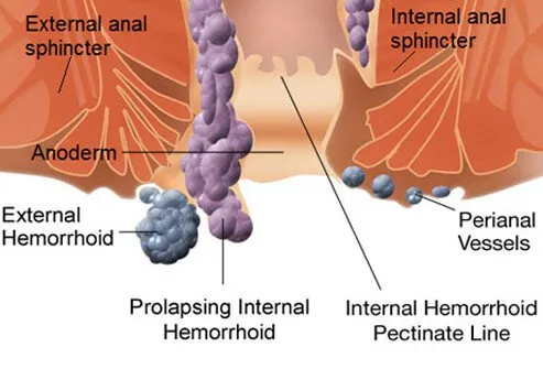 Symptoms of Hemorrhoids