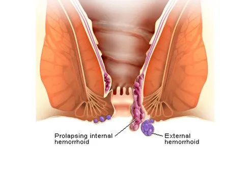 External Hemorrhoids