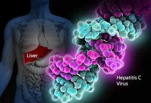 What is hepatitis C, HCV infection, hep C? Is hepatitis C curable? What are the cures for hepatitis C?